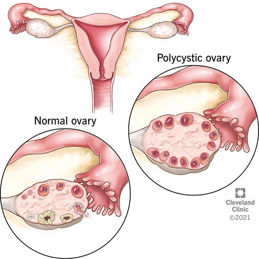 The Role of Hormones in PCOS: What Every Woman Should Know